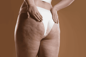 cellulite come si elimina