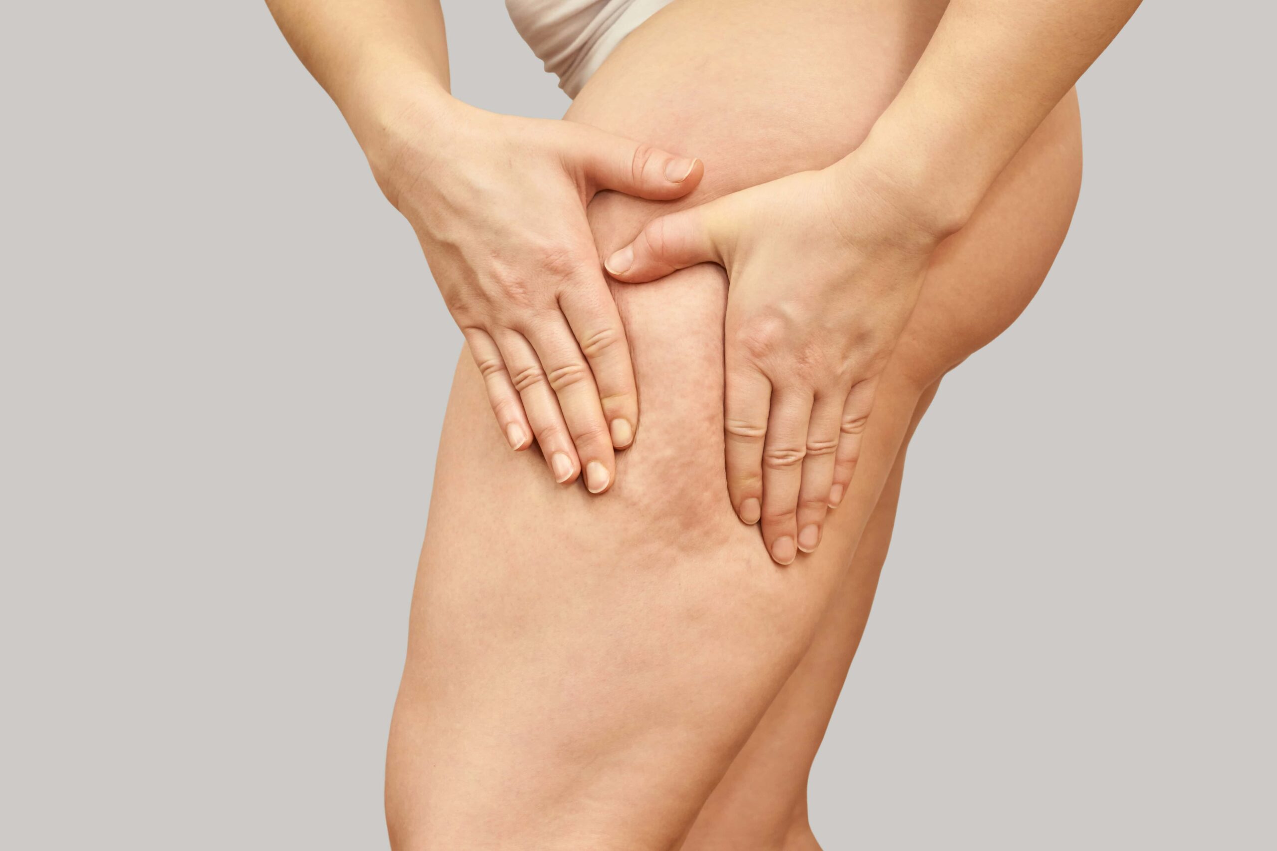 cellulite gambe