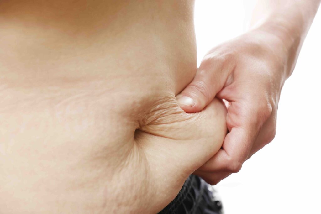 cellulite pancia cause sintomi