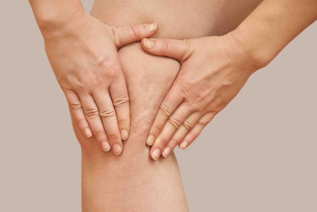 cellulite ginocchia ritenzione idrica