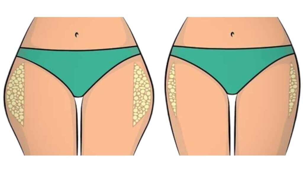 culotte de cheval come eliminare