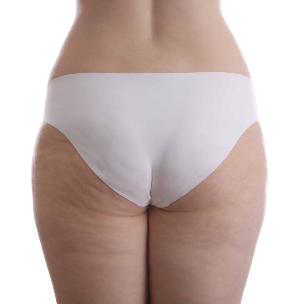 cellulite sedere