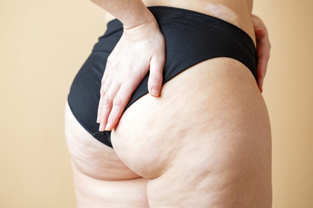 cause cause-ritenzione idrica in menopausa