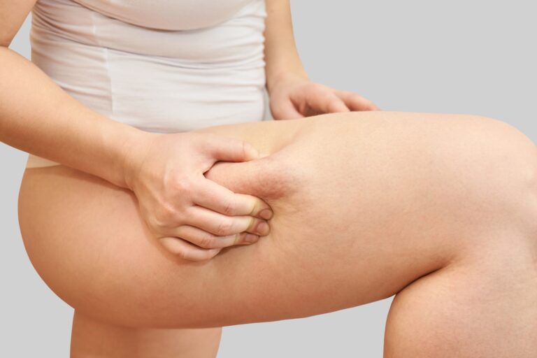 ritenzione idrica in menopausa