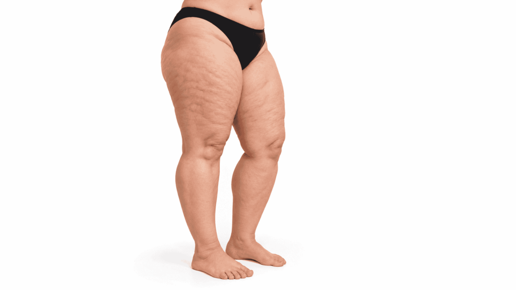 gambe lipedema profilo