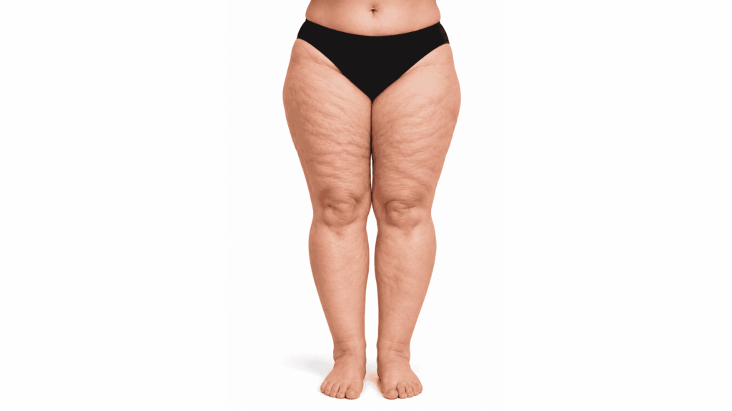 lipedema gambe frontali