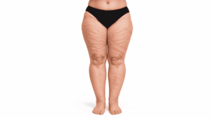 lipedema gambe frontali
